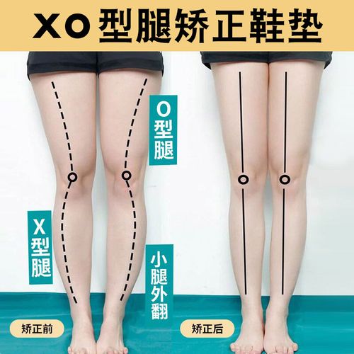 xo型腿矫正鞋垫小腿外翻o型腿x型纠正腿型膝盖内扣矫正器直腿神器