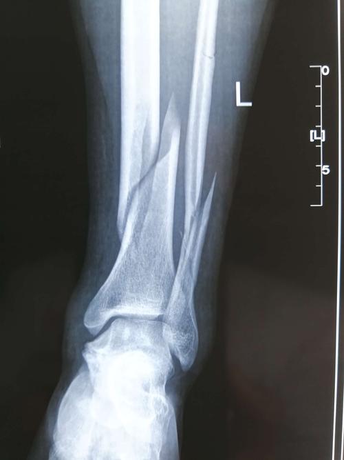 胫腓骨远端骨折是指距离胫骨远端关节面10cm内的骨折,其多为高能量