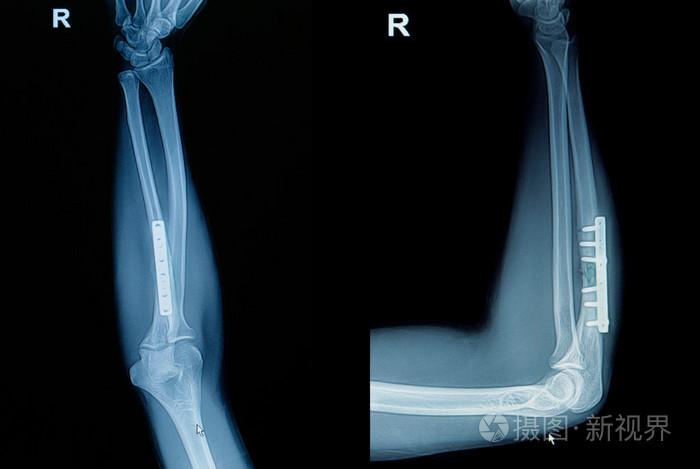 薄膜x 射线手腕骨折: 显示骨折桡骨骨 (前臂