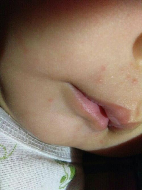 最近几天不知道怎么回事,宝宝的鼻子,鼻子下面和嘴角老是长小红点