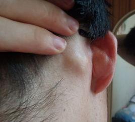 北京玉泉医院耳鼻喉申力医生:耳后长包需尽快就医,小心淋巴癌!