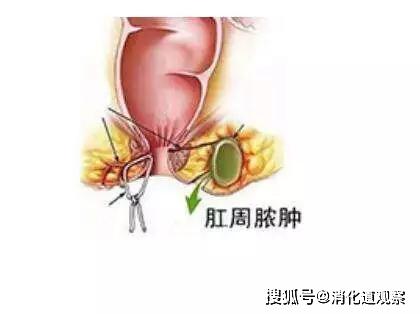 肛周脓肿是发生于肛门,肛管和直肠周围的急性化脓感染性疾病,属于细菌