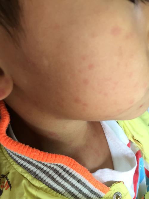 小孩5岁,高烧40度不退,还起了疹子,请问是什么疹子?