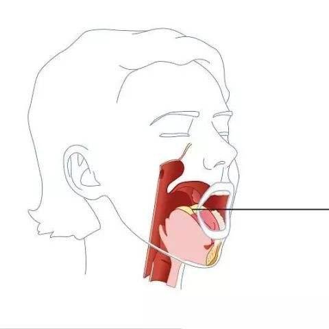 舌咽神经痛是普通的嗓子疼吗