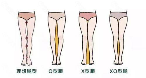 全国xo型腿矫正口碑医院名单汇总含各医院腿型矫正价目表