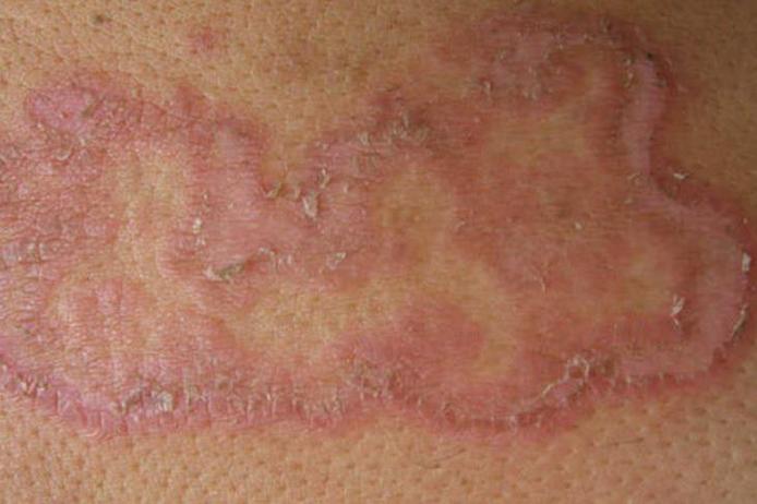 牛皮癣牛皮癣也叫银屑病,会导致皮肤表面长红斑,表面还会覆盖着许多