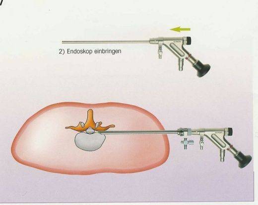 图解椎间孔镜手术摘除突出椎间.