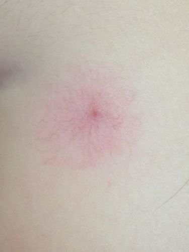 我女儿6岁,脸上在去年就发现有一个小红点,今天一看血丝扩散那么大,我
