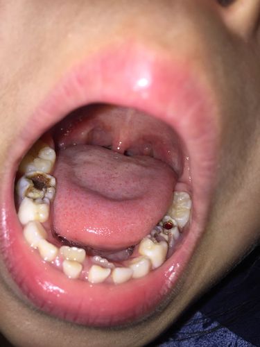 7岁小孩牙齿被蛀虫后有颗像红钻似的东西?