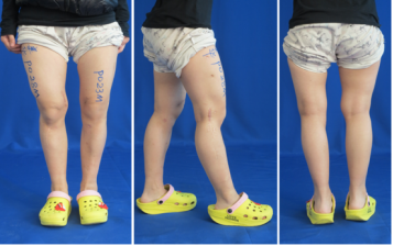 膝外翻畸形微创手术矫正|膝关节|畸形|微创|矫正|截骨|小腿|步态