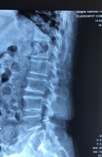 椎间孔镜下腰椎管狭窄症椎间孔成形270度减压术 女,73岁,右下肢疼痛