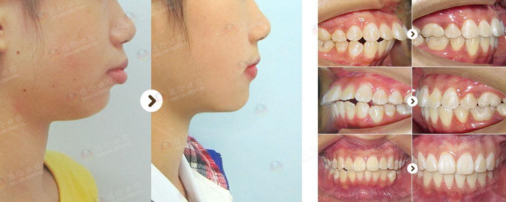牙齿症状:上颌前突 治疗方式:金属托槽矫正