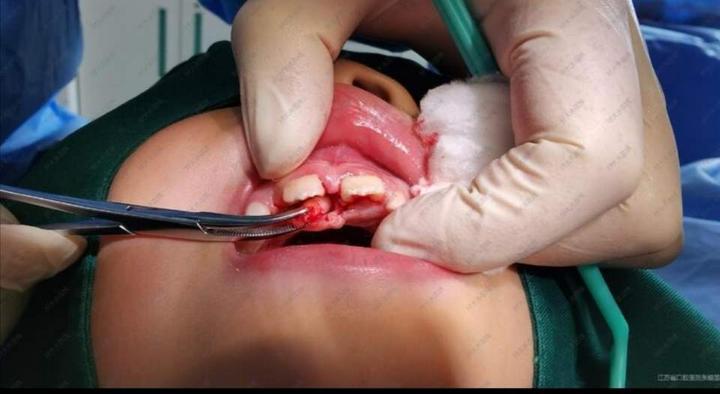 患儿,男,七岁,因门牙间隙过大,拍片发现埋伏倒置多生牙一颗,经cbct