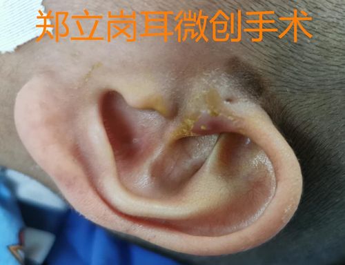 儿童耳前瘘管发炎后需及时手术,避免造成反复感染_先天性耳前瘘管