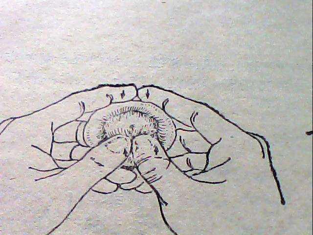 手法复位 用手握住包皮水肿处及龟头,逐渐加压促使水肿液向阴茎根部