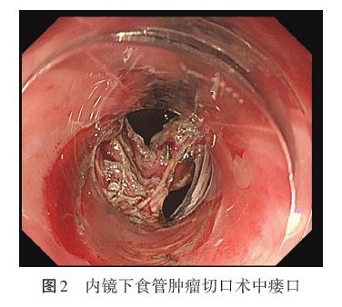 病例析评内镜下食管肿瘤切除术中并发纵隔胸膜瘘1例