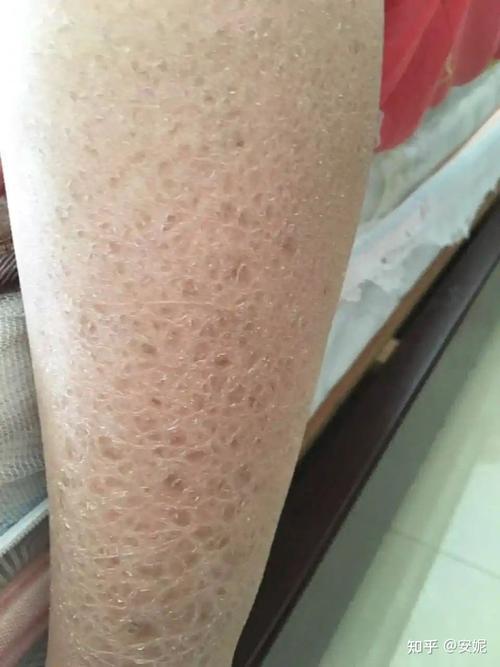 鱼鳞病(又称蛇皮病)是一种常见的角化障碍性皮肤病,75%属遗传.