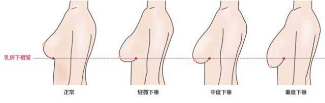 轻度下垂:乳房下极超过乳房下皱襞1-2cm