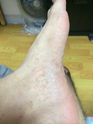 医生您好,最近小腿和脚侧脚背都有这样的红点,像是毛细血管末端破裂一