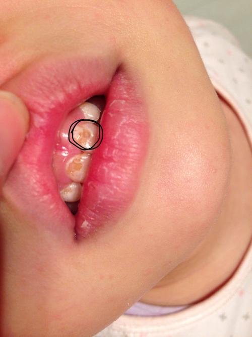 孩子3岁多,门牙上的蛀牙特别严重,左门牙上有蛀牙洞