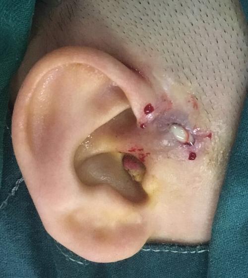 耳前瘘管感染期可以手术吗_先天性耳前瘘管_先天性耳前瘘管治疗方式