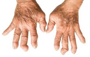 手指类风湿性关节炎变形怎么办,贵阳治类风湿的费用是多少钱