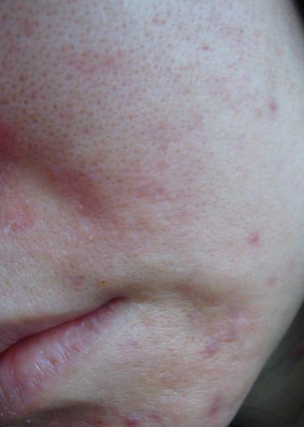 皮肤性病科 皮肤科 湿疹 → 脸上总是红红的,毛孔很粗,七八年了,有医