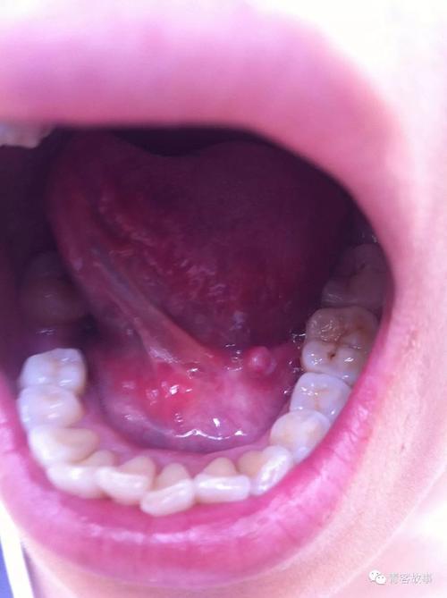 吃个槟榔后口腔内出现的肿块 