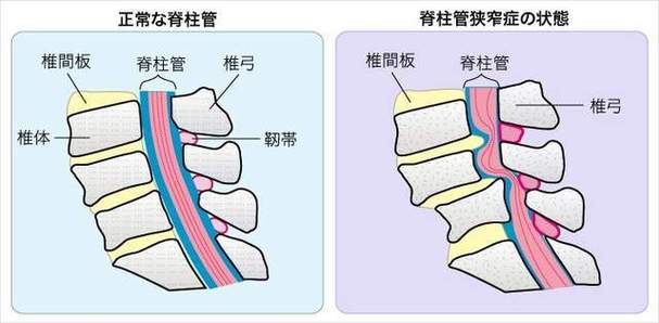 椎管的管腔前壁是椎间盘,后纵韧带,后壁是椎弓板,黄韧带和关节突关节