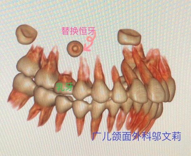 处理,颌骨囊肿包绕恒牙胚(颌骨囊肿的处理在另一篇文章中有详细介绍)