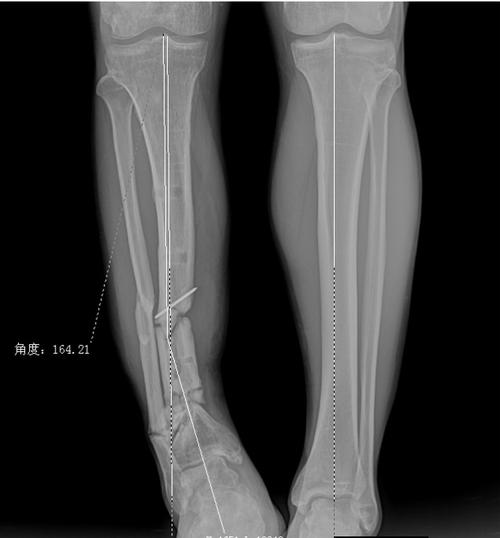 健侧肢体见右侧胫骨明显短缩,力线不良 这是患者去了外固定架后的小腿