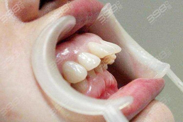 牙性龅牙和骨性龅牙的区别对照图快速辨别骨性龅牙和牙性的根本区别