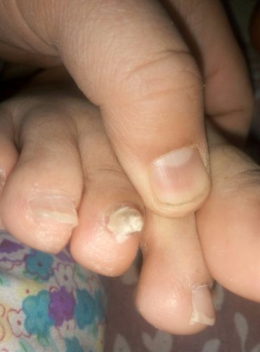 脚趾甲里面长肉垫把指甲顶起是什么病么很多年了