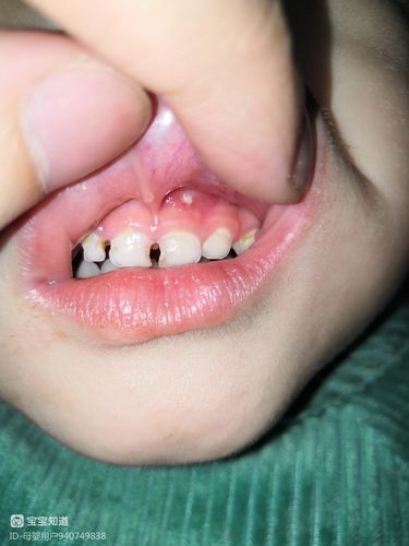 3岁4个月大的男孩宝宝,中间上门牙龈出现脓包,反复一直有