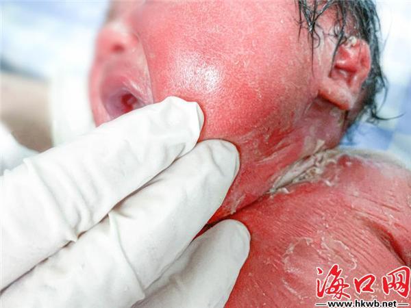 (海南现代妇婴医院供图)"鱼鳞宝宝"诞生5月31日,星星的妈妈在海南现代