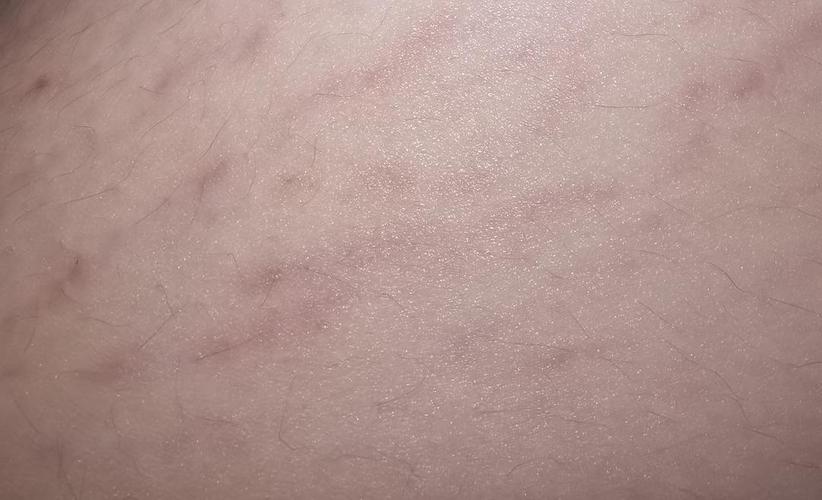 请问大腿上这种发红的纹路,是肥胖纹吗(破案了 是生长纹01