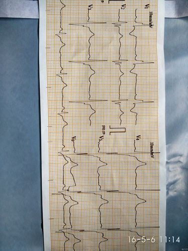 这是一位体检的女性患者的心电图
