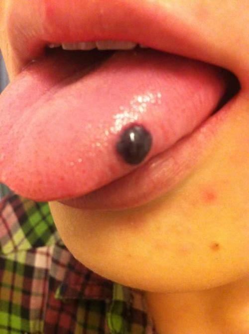 吃饭的时候发现舌头边缘突然出现个血泡.