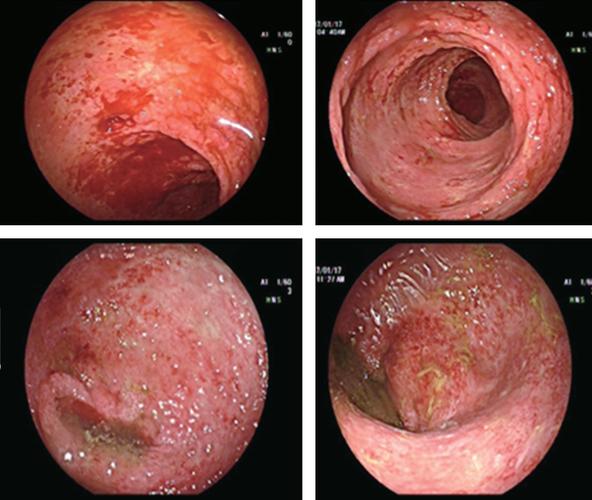 图15-4 2017年1月17日肠镜(全大肠及回肠末端充血水肿,糜烂,出血)