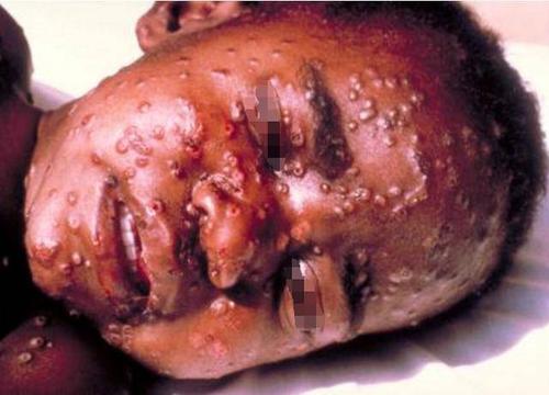 天花(smallpox)是由天花病毒引起的一种烈性传染病,也是在世界范围内