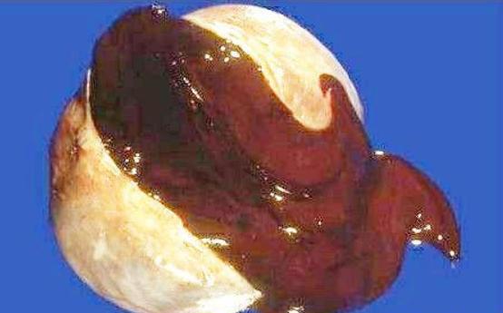 什么是卵巢巧克力囊肿?