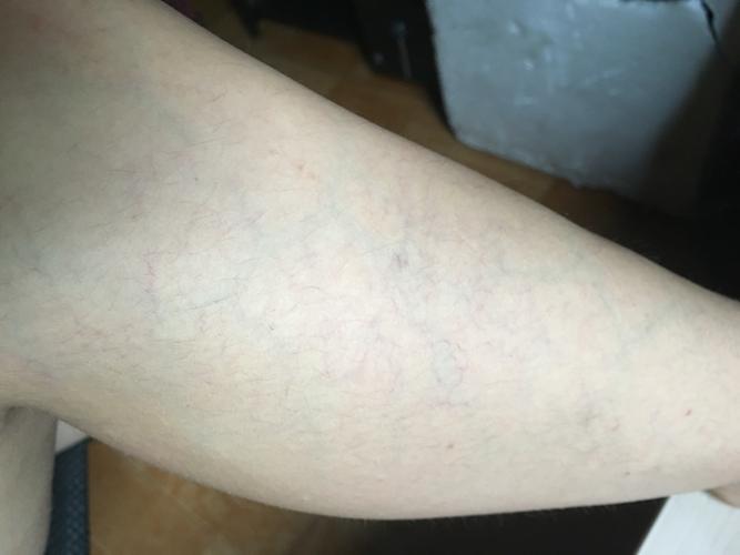 [小夫妻]腿上身上有有很多紫色毛细血管正常吗?