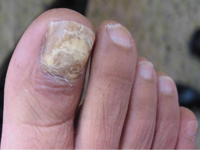6,慢性甲沟炎型灰指甲:表现为外侧甲皱襞及近端甲皱,表皮护膜变质或变