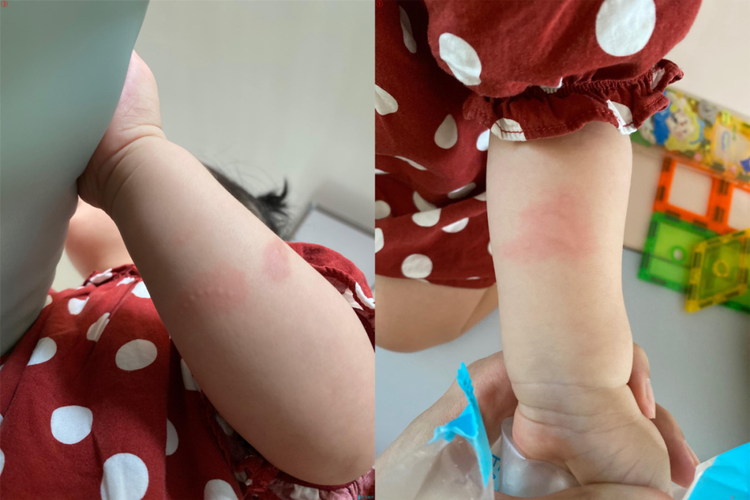 孩子出现皮疹,是荨麻疹还是食物过敏?怎么处理?