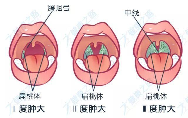 ①腭扁桃体就是我们常说的"扁桃体",扁桃体位于舌腭弓和咽腭弓之间的