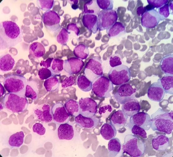 病例分享:骨髓形态学和流式细胞学完美演绎诊断慢性粒-单核细胞白血病