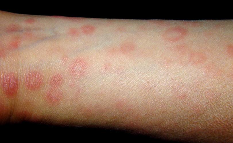 丘疹性二期梅毒感染疹图片下肢斑疹性二期梅毒疹图片中梅毒感染的症状