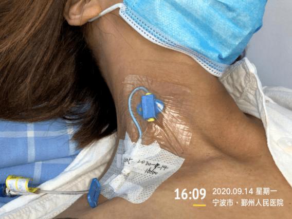 2020-09-17 完成化疗输液,这一次患者主动要求拔除颈内静脉导管,并