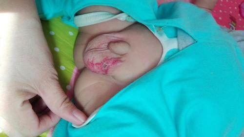 宝宝阴囊一侧有血管瘤,有宝妈知道或是带宝宝看过的吗?