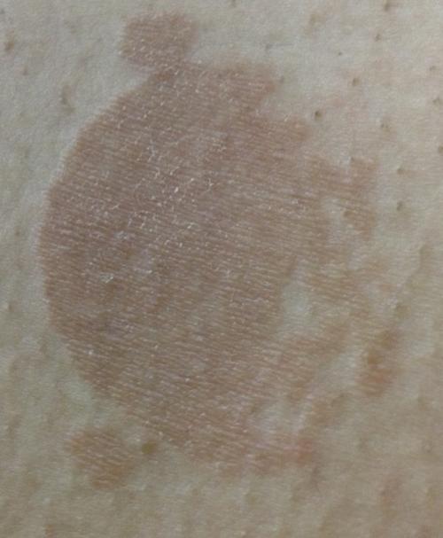 这是什么皮肤病?
